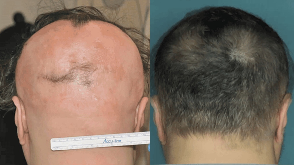 Treatment for hair-destroying disease