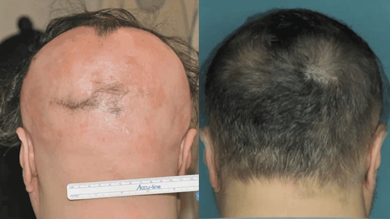 Researchers have found a potential treatment for the hair-destroying disease alopecia areata.