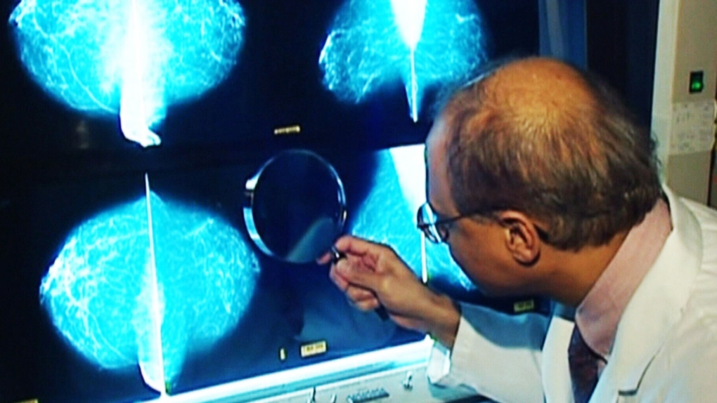 CTV National News:  Best options for breast cancer