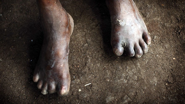 This July 7, 2010 photo shows the feet of Luis Siqueira Aforn, 65, whose toes were chewed by rats while he was sleeping on the ground in Hauana, East Timor, south of Oe-cusse town. (AP Photo/Wong Maye-E)