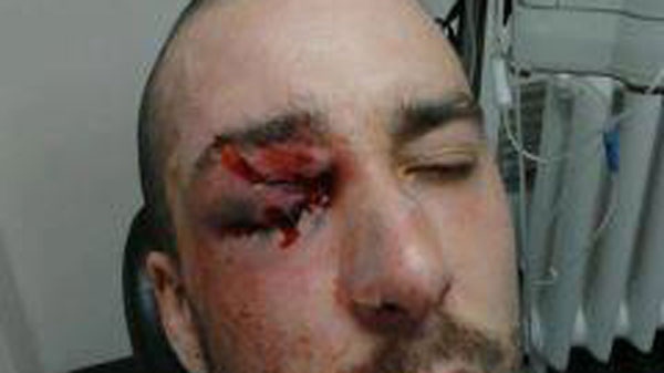 A photo from CLASSE of the CEGEP student who allegedly suffered an eye injury in Montreal on Wednesday.