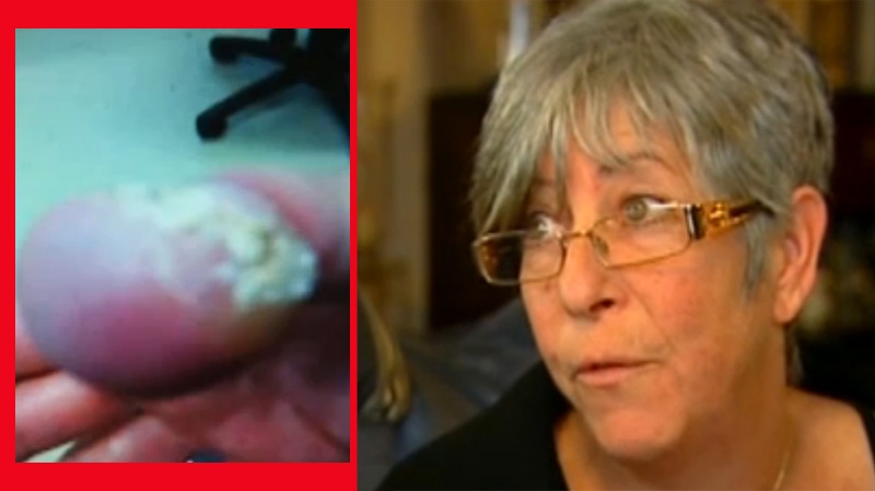 Judy Jacobson endured intense pain and damage to her thumb (at left, seen after the treatment) as a result of what seemed like a minor mishap at the time. 