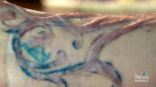 CTV Montreal: Tattoo removal leaves ugly scars CTV News