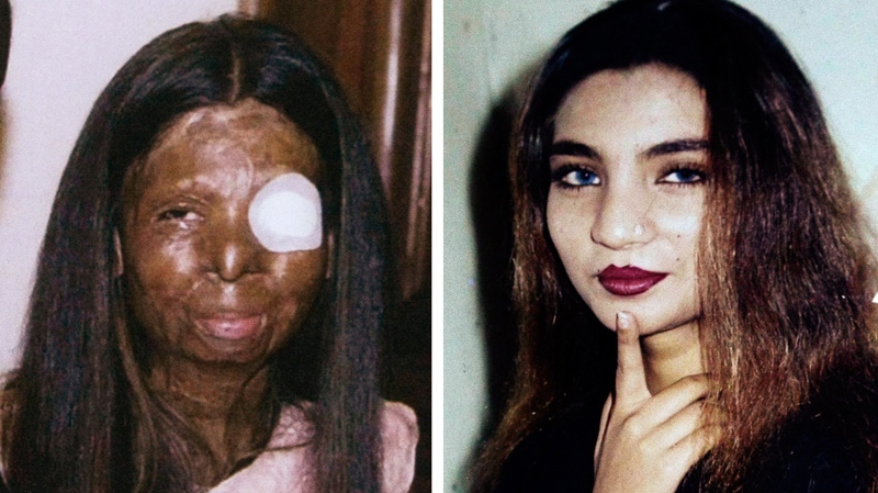 This combination of two undated photos provide by the family shows on the left, Fakhra Younus, some time after an acid attack twelve years ago, allegedly carried out by her then-husband, an ex-lawmaker and son of a political powerhouse; and on the right, Younus sometime before the attack. 