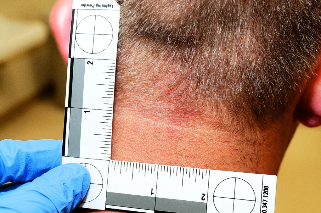 Measuring a red mark on Darren Wilson's neck