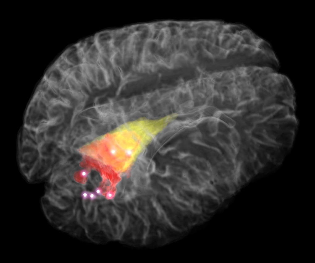 Brain tumour probe