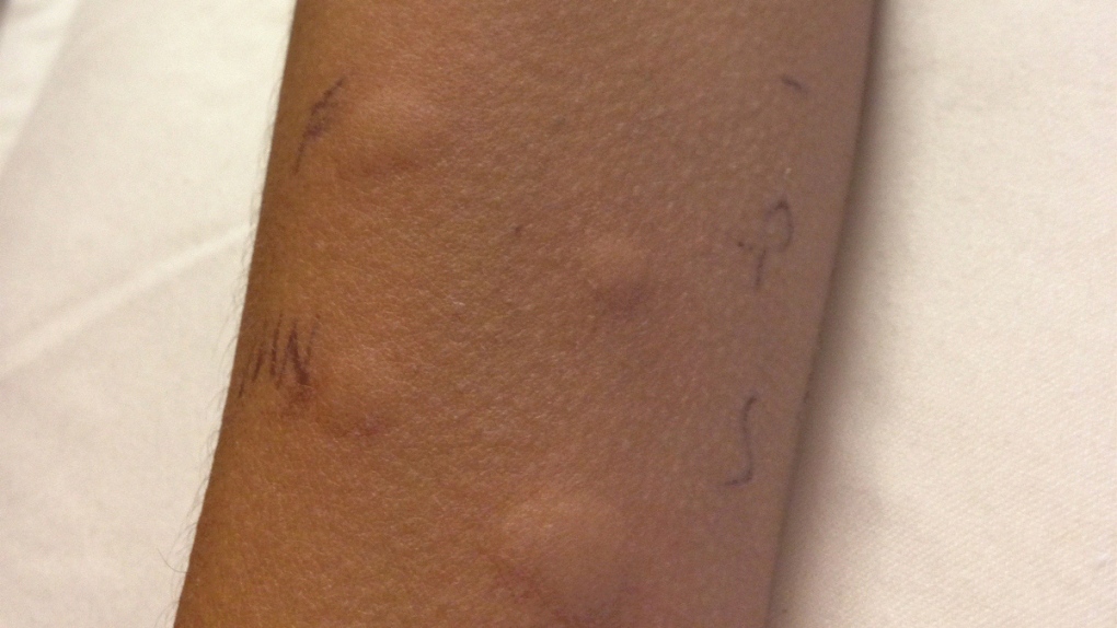 A child's arm shows allergic reactions