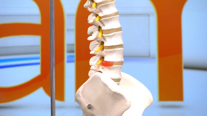 A Toronto-based doctor has created a series of targeted exercises aimed at improving the quality of life for patients suffering from spinal stenosis, a painful condition affecting parts of the spine.