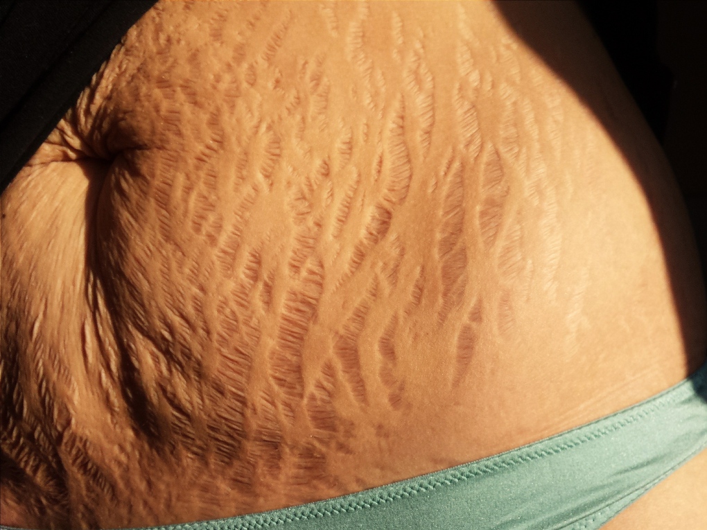 Love Your Lines: Stretch marks go viral in support of women