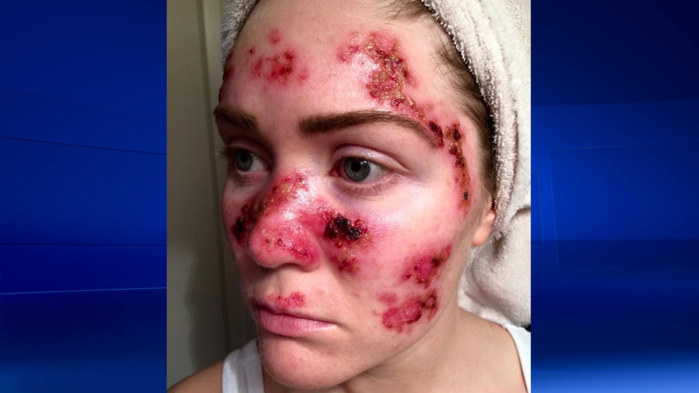 Tawny Willoughby selfie of her skin cancer scars