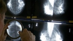 A radiologist uses a magnifying glass to check mammograms for breast cancer in Los Angeles on May 6, 2010. (AP / Damian Dovarganes)