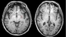 An MRI brain scan. (Dr. Sandra Black / Sunnybrook Health Sciences Centre)