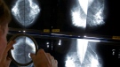 A radiologist uses a magnifying glass to check mammograms for breast cancer in Los Angeles, May 6, 2010. (Damian Dovarganes/AP)