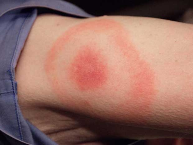 A 'bull's-eye' rash, considered one of the tell-tell signs of Lyme disease, is seen in this image provided by the U.S. Centers for Disease Control.
