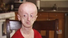 Devin Scullion, who has progeria, is turning 19-years-old -- a birthday his mother never thought she'd be able to celebrate with her son. 