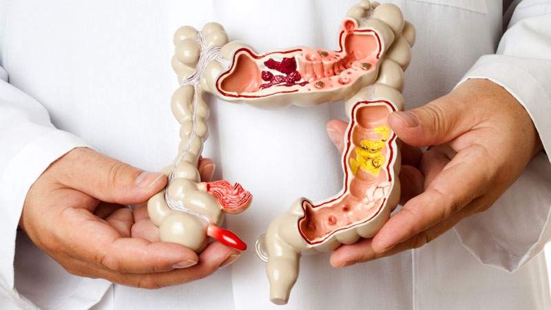 Irritable Bowel Syndrome linked to low vitamin D