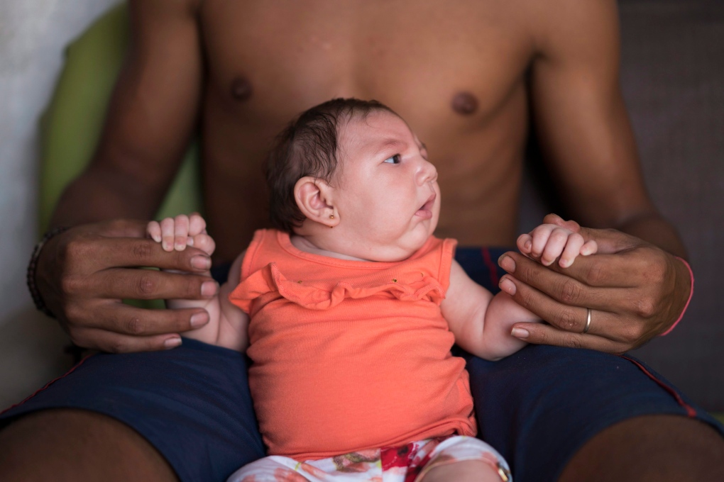 Luiza, baby born with microcephaly
