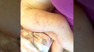 Katrina Boblin's photograph of the red bumps on her daughter's legs during their vacation in Cancun, Mexico (Courtesy: Katrina Boblin)