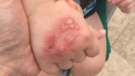 Sophie Cranley's son developed this rash while they vacationed in Cancun, Mexico.