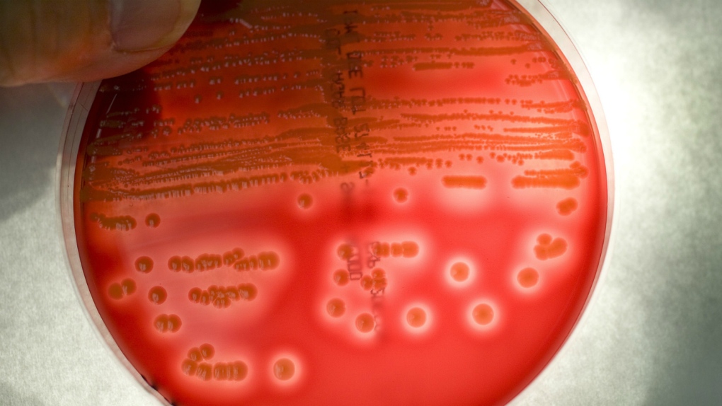 Superbugs at fault for infections in hospitals