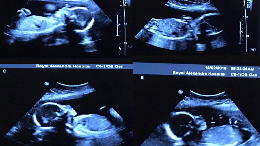 Webb quadruplets ultrasound