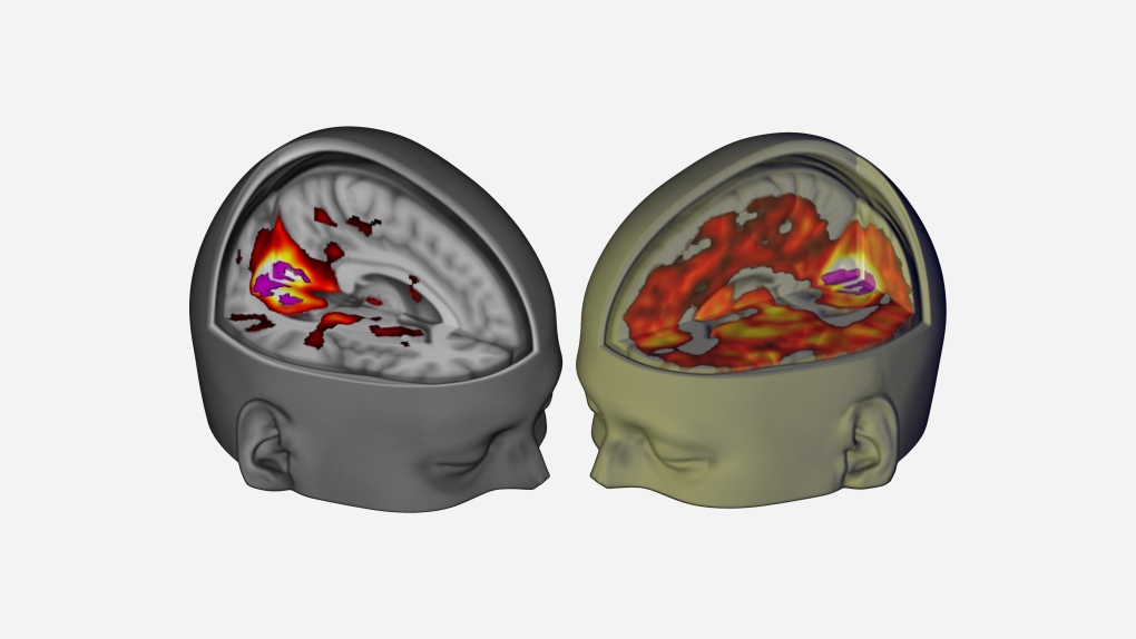 LSD brain