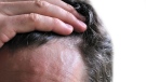 Dandruff is the most common scalp disorder on the planet. (Meryll/shutterstock.com)
