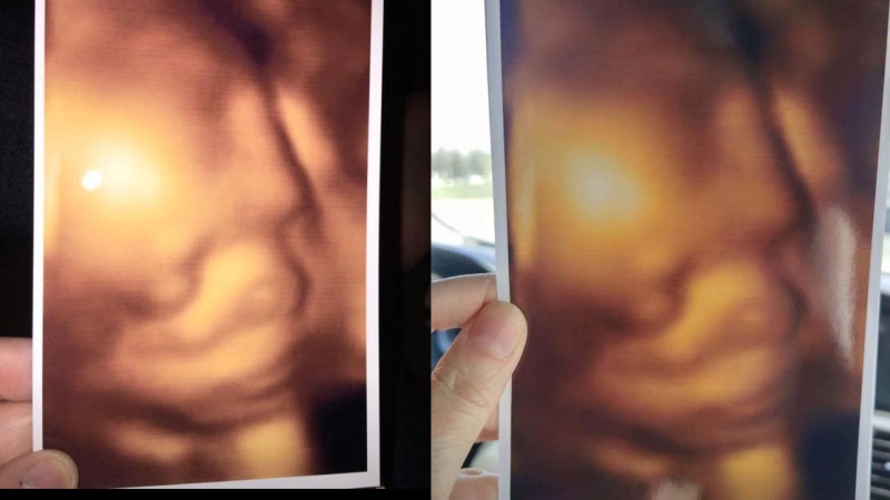 Jenn Cusimano shared an image from a recent 3D ultrasound on Facebook alongside the same photo given to another expecting mom during a visit to the same clinic. (Facebook)