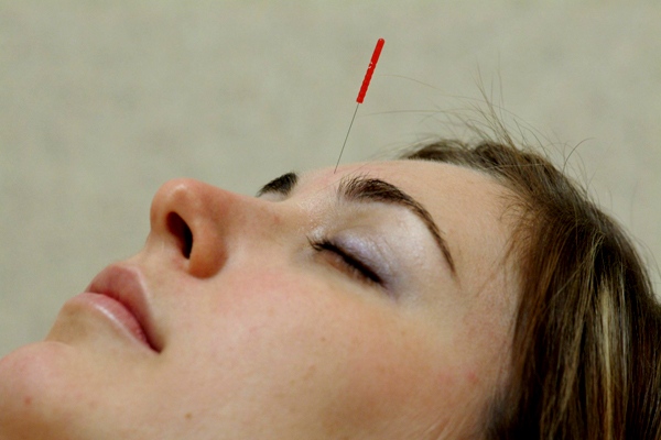 Acupuncture could reduce hot flashes