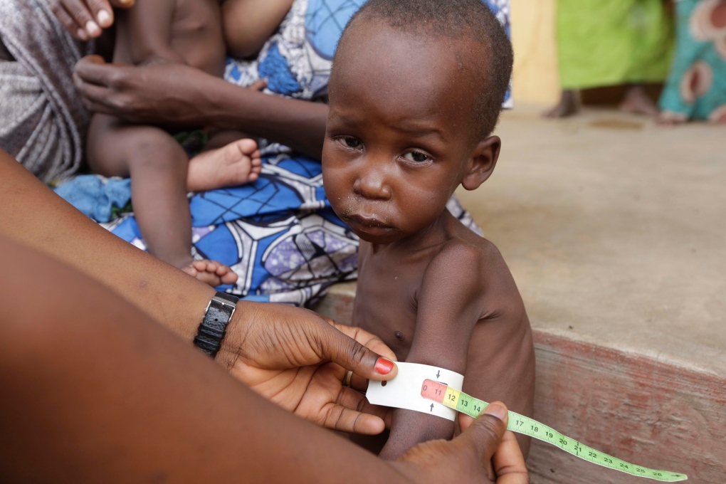 Malnourished child in Nigeria 