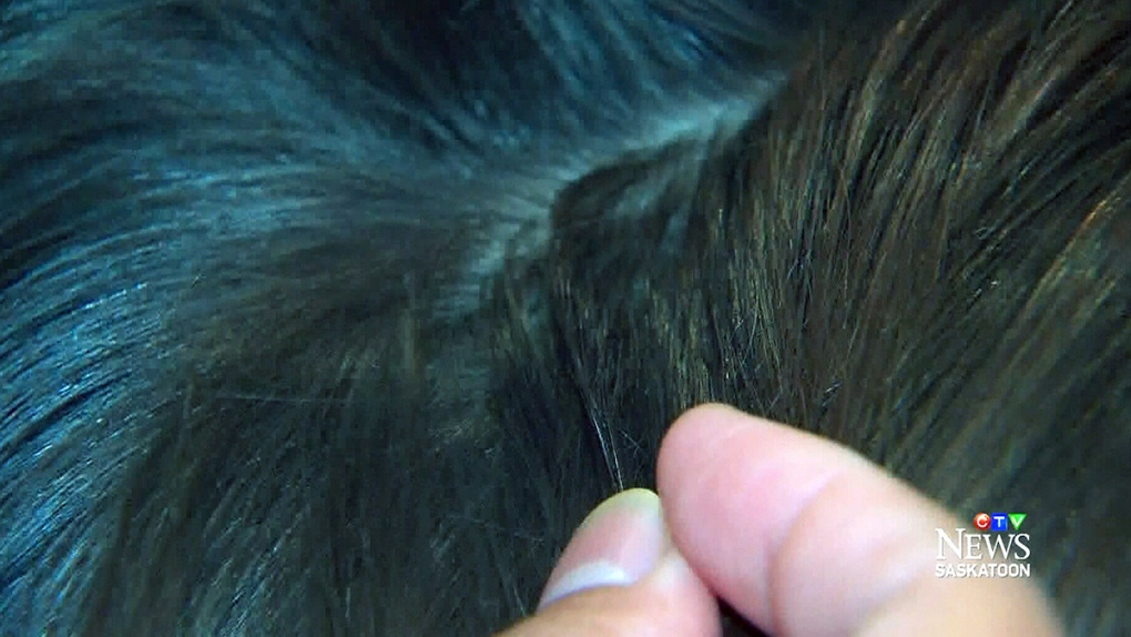 Hunting for head lice: Be ready for back to school