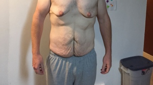 Sudden weight loss also came with excess skin all over Chris Gair’s body. (source: Chris Gair)