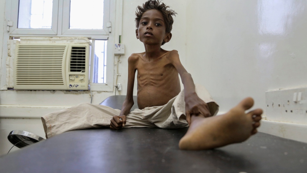 Starving boy in Yemen (UNICEF)
