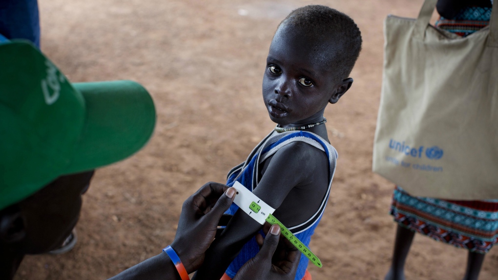 Child in Sudan treated by UNICEF