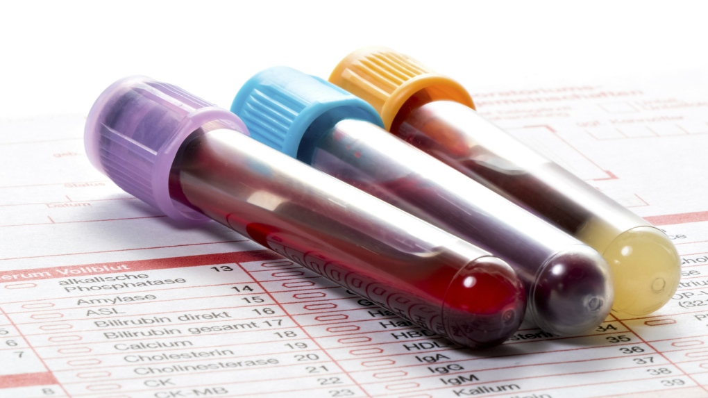 blood test for tuberculosis