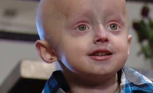 'My superhero': Edmonton boy, 5, living with rare rapid aging disease