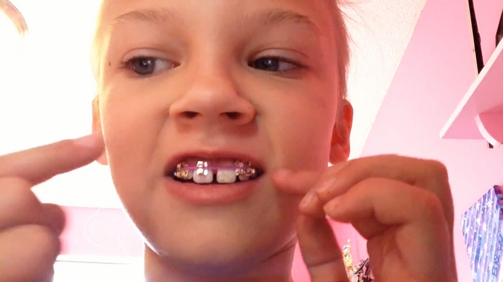 Orthodontists Warn Against Homemade Braces Ctv News - Fake Braces Diy Rubber Bands
