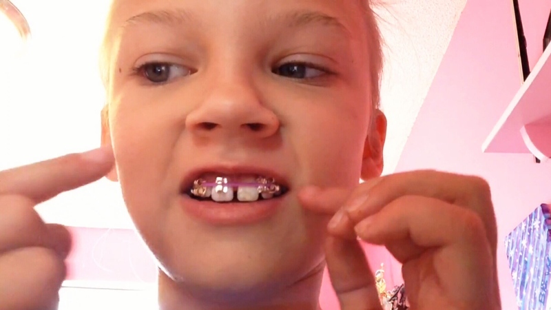 A girl tries to make homemade braces using elastics and earring backings. (YouTube)