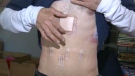 Bandages cover Dave Nickerson's stab wound as well as the cuts surgeons made to drain his lungs and access his diaphragm wound