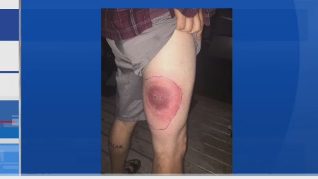Stephen McKellar from Middle Cornwall, N.S., is recovering after being bitten by a spider that left a painful skin reaction last week. 