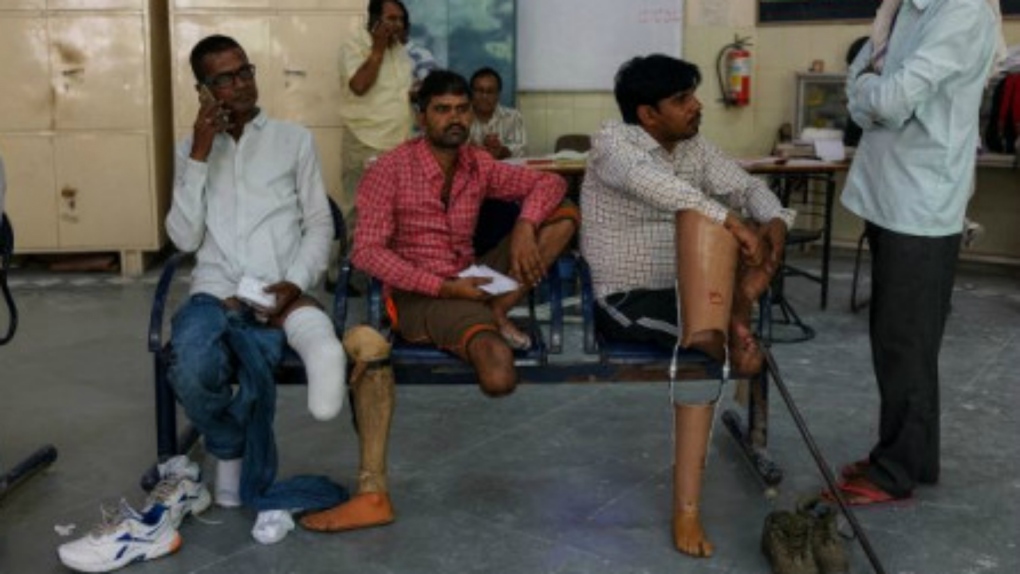 Cheap prostheses being produced in India
