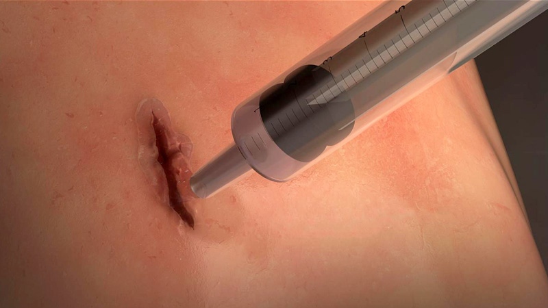 New super-flexible surgical glue can seal wounds in seconds: study