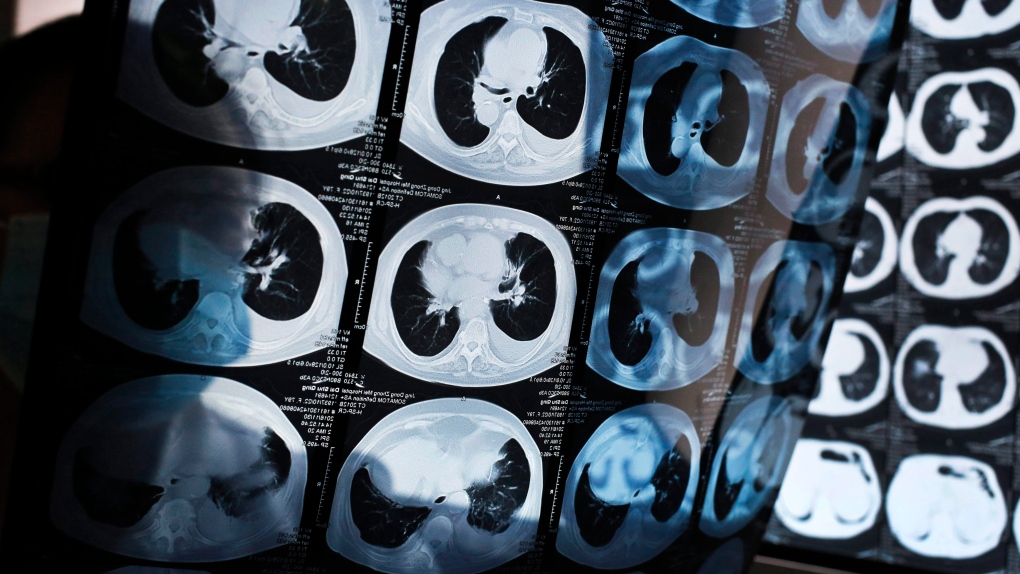 CT scans of lung cancer patients