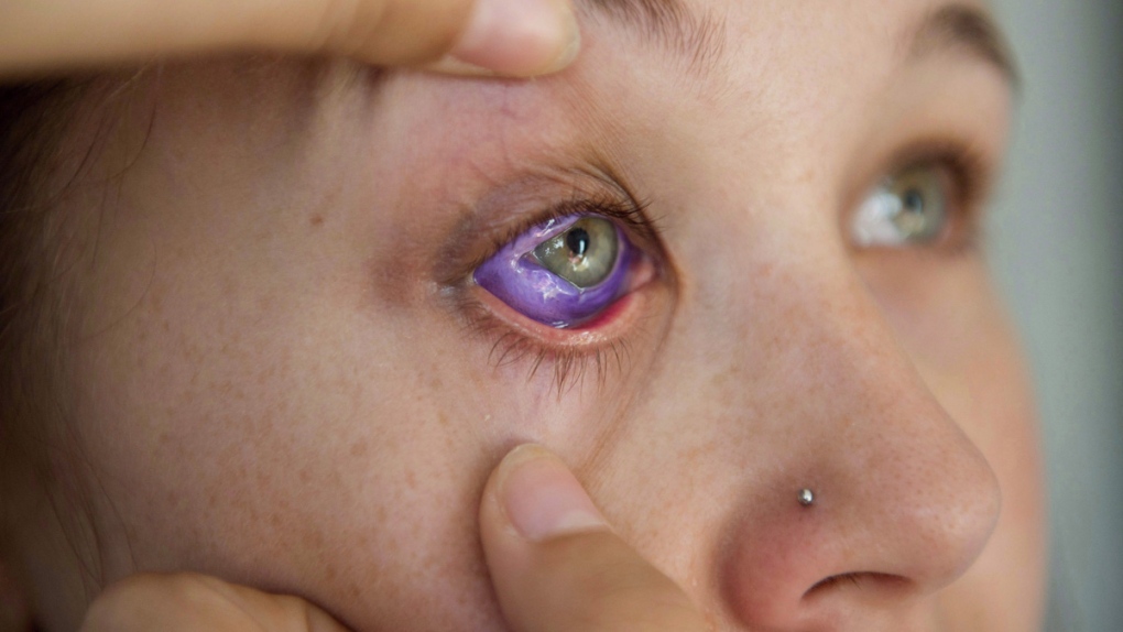 Catt Gallinger's botched eyeball tattoo