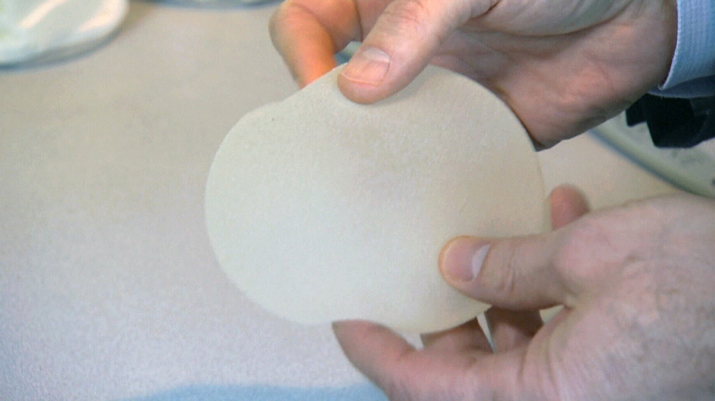 breast implant