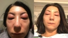 Two photos Isabelle Kun uploaded to her Facebook page Thursday showing the allergic reaction affecting her eyes (Facebook)