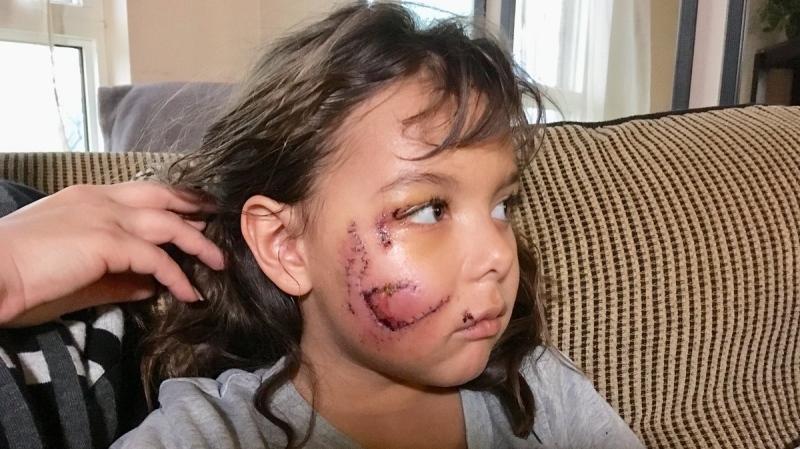 Windsor girl recovering after getting attacked by a dog, Jan. 11, 2018. (Stefanie Masotti / CTV Windsor)