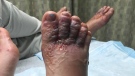 Katie Stephens posted photos of her feet stating both she and her boyfriend have worms. (Facebook)