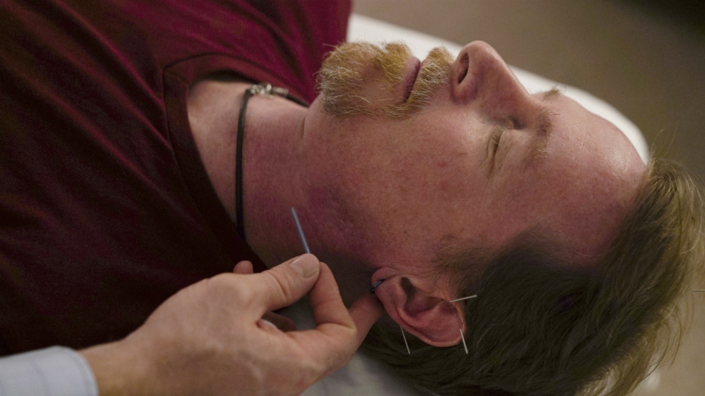 Officials turn to acupuncture over opioids
