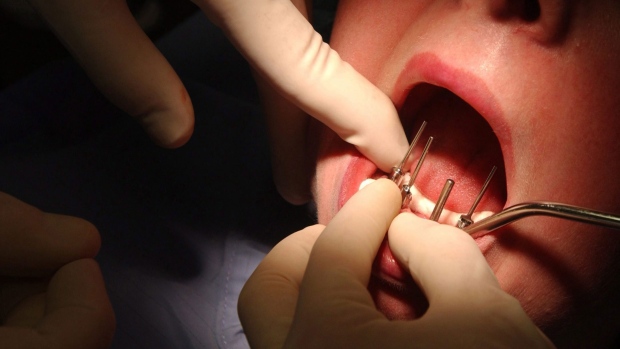 Dentists say they’re seeing more cracked teeth due to pandemic stress